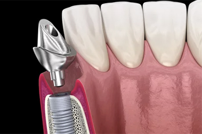 アバットメント